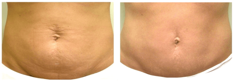 Como tratar a flacidez da barriga de uma forma não invasiva