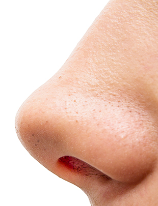 imagem nariz com os poros dilatados