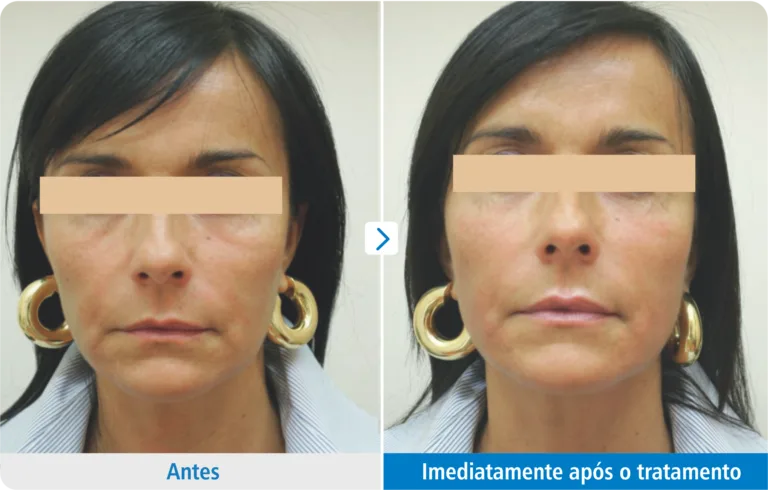 ultraformer-papada-antes-depois2