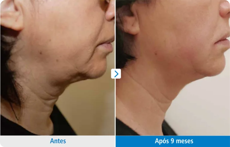 ultraformer-papada-antes-depois