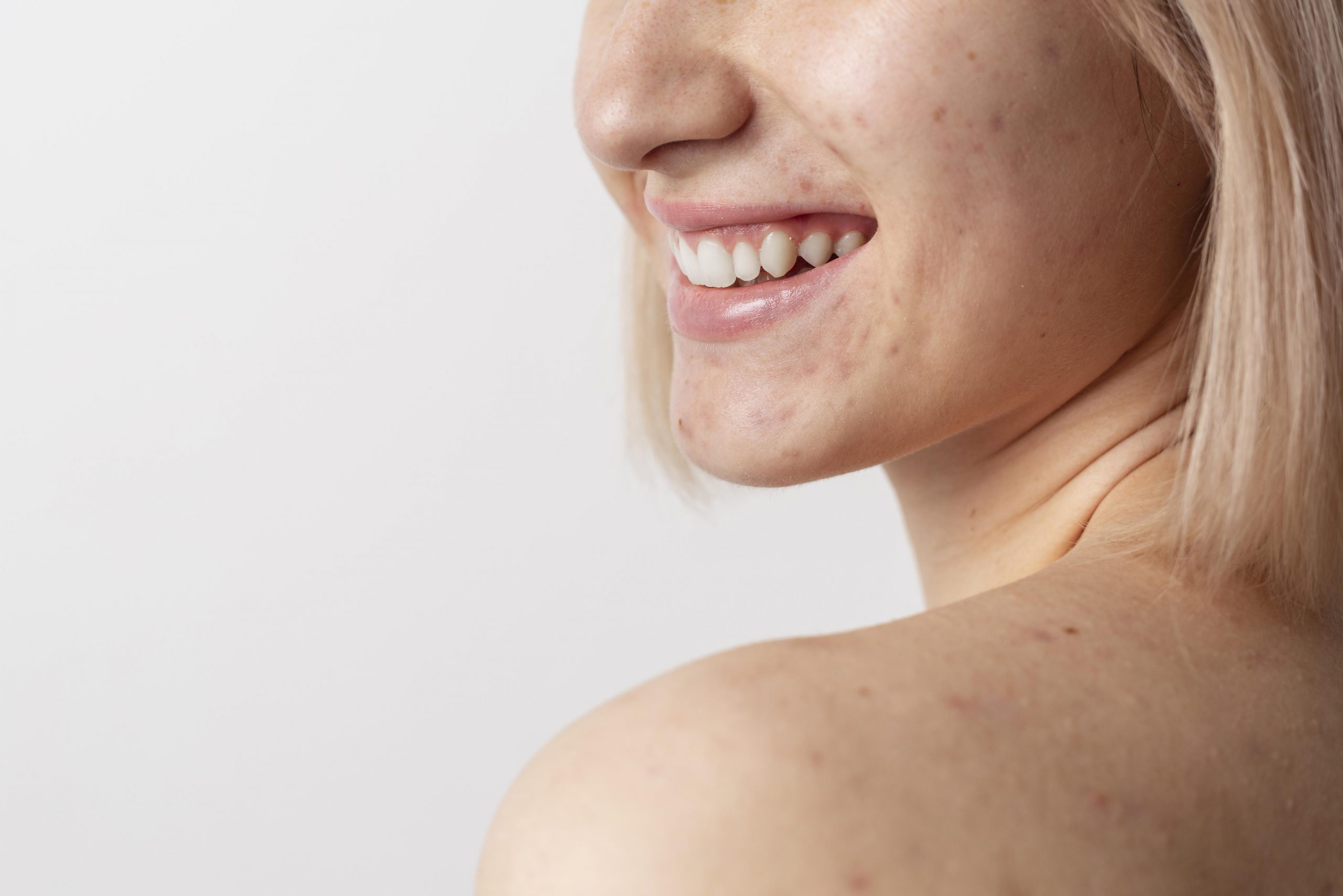 Sem receitas caseiras: tratamentos que eliminam cicatrizes de acne