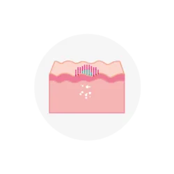 Rejuvenescimento completo multinível - Discovery PICO Plus