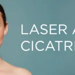 Mulher com acne e cicatrizes na pele representando os benefícios do tratamento de acne e cicatrizes com lasers dermatológicos.