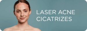 Mulher com acne e cicatrizes na pele representando os benefícios do tratamento de acne e cicatrizes com lasers dermatológicos.