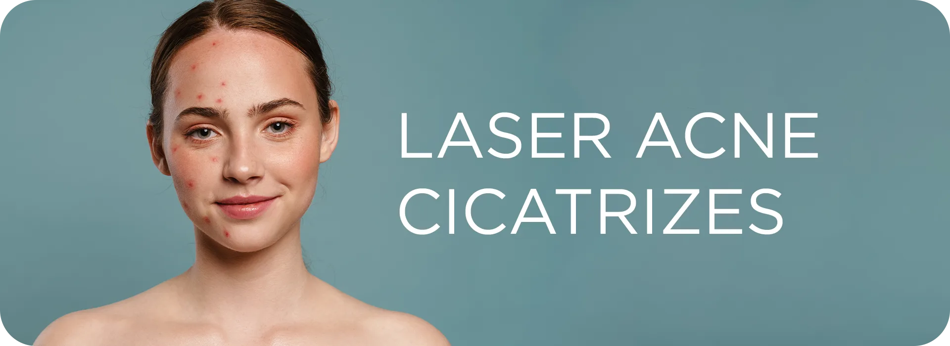 Mulher com acne e cicatrizes na pele representando os benefícios do tratamento de acne e cicatrizes com lasers dermatológicos.