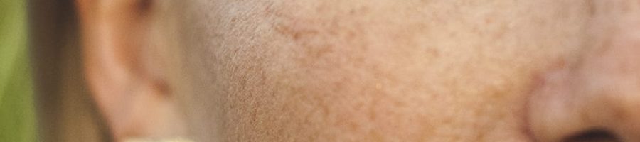 tratamento-contra-melasma