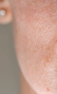 Poros-tratamento-440x720